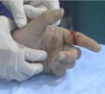 علائم و درمان پارگی تاندون دست