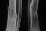 درمان های غیر جراحی شکستگی استخوان های ساق پا