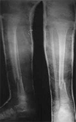 درمان های غیر جراحی شکستگی استخوان های ساق پا