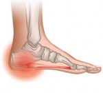 روش هایی برای درمان و کاهش درد پاشنه پا