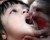 درمان فلج اطفال